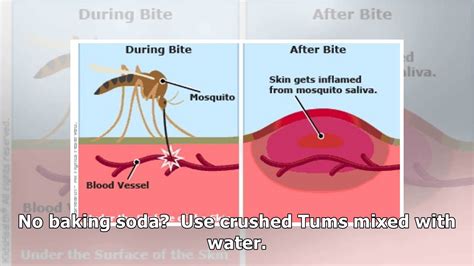 Ways To Stop Mosquito Bites From Itching YouTube