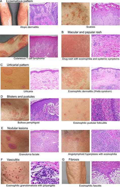 Eosinophilic Pustular Folliculitis Histology