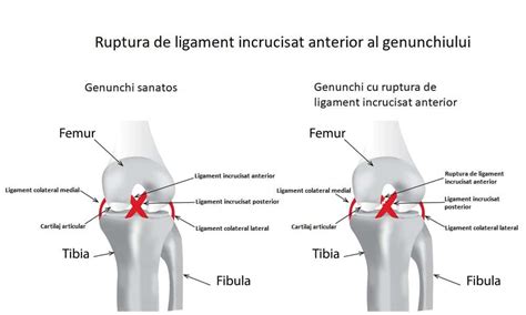 Ruptura Ligament Incrucisat Anterior LIA Cauze Tratament Dr