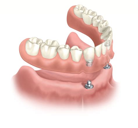 Herausnehmbarer Zahnersatz Vor Und Nachteile Implant