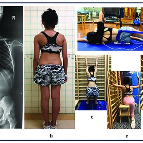 Exercises demonstration for major right thoracic curves. a: a major... | Download Scientific Diagram