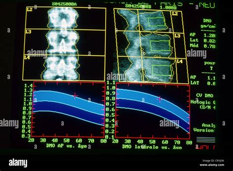 La Densitom Trie Osseuse Banque De Photographies Et Dimages Haute