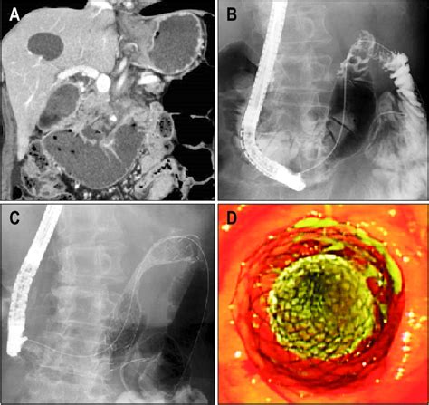 Stent Placement Procedure A A Computed Tomography Scan Revealed A Download Scientific