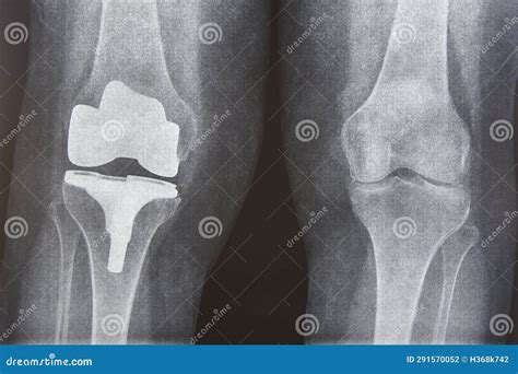 Appareil De Remplacement Du Capot Du Genou Implant Titane Arthrose