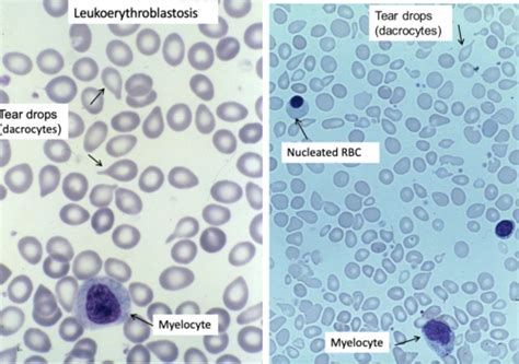 Pathophys Exam 1 BLOOD Flashcards Quizlet