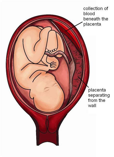 Placental Abruption