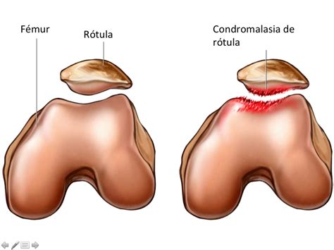 Condromalacia De R Tula Traumatologo