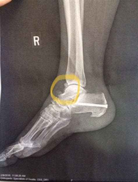 Insertional Achilles Tendinopathy Differential Diagnosis And Treatment By Seth O Neill And Tom