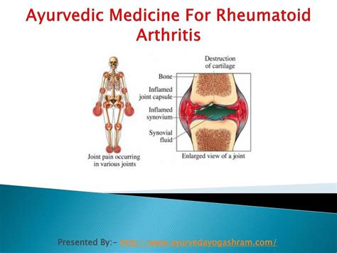 PPT Ayurvedic Medicine For Rheumatoid Arthritis PowerPoint