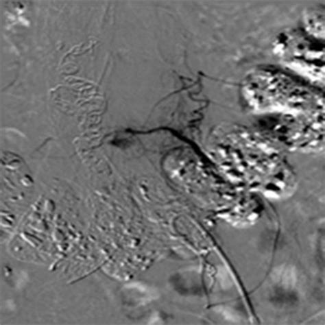 Embolization Of Aortic Aneurysm Sac Tipe II Endoleak Direxion