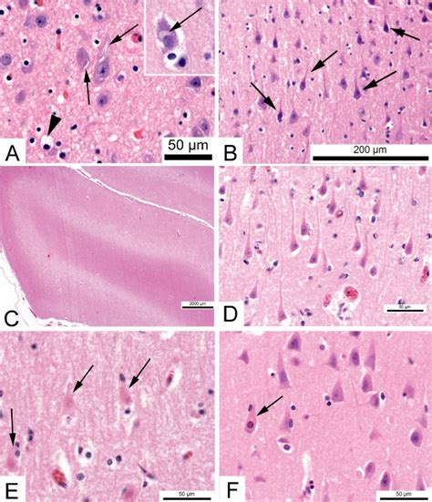 Diffuse Axonal Injury Histology