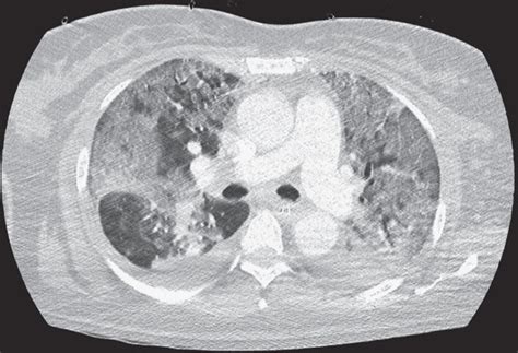 Axial Chest Computed Tomography Scan A Before The First