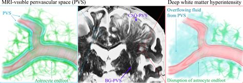 Location Specific Characteristics Of Perivascular Spaces As The Brains