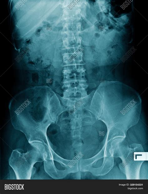 X-ray Image Lumbar Image & Photo (Free Trial) | Bigstock