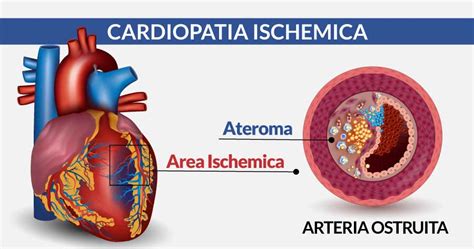 Cardiopatia Ischemica Cardio Center Napoli