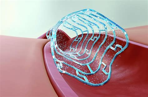 Drug Eluting Stent Photograph By Scientificanimations Science