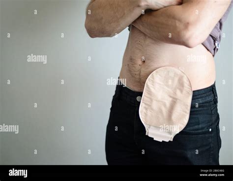 Front View On Colostomy Bag Attached To Man Patient Medical Theme