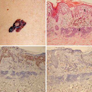 Melanoma Maligno Associado A Nevo Melanoc Tico H E Componente De