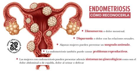 Endometriosis diagnóstico tardío