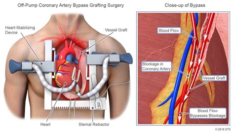 Coronary Artery Bypass The Cardiothoracic Surgeons Bread And Butter