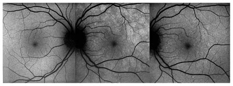 Fundus Auto Fluorescence Faf In Mewds Geographic And Confluent Areas