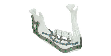 Kls Martin Ips Implants Mandible Reconstruction