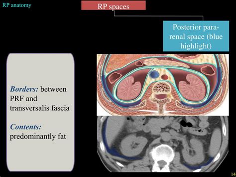 Ppt Overview Of Retroperitoneal Anatomy Masses And Disease Spread