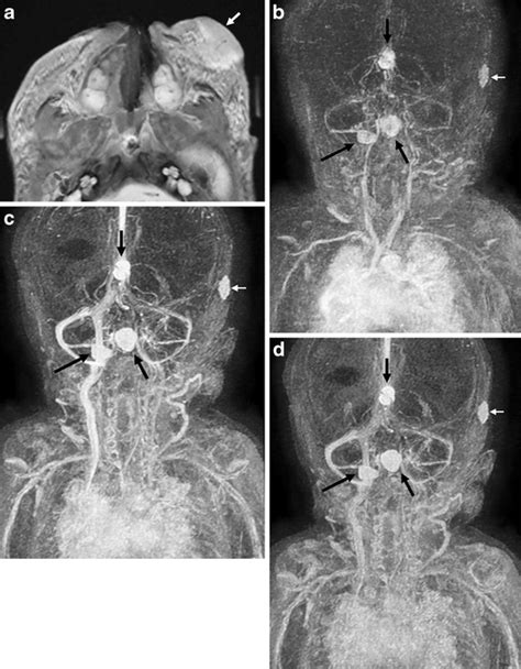 Phaces Syndrome Posterior Fossa Malformations Hemangiomas Arterial