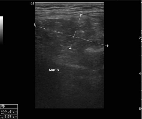 Lipoma Ultrasound Radiology