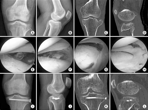 Figure From Arthroscopically Assisted Reduction And Internal Fixation