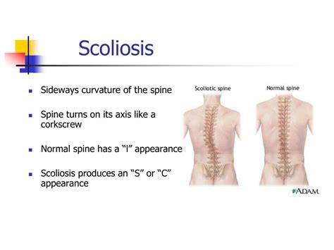 Ppt Scoliosis Screening Powerpoint Presentation Free Download Id