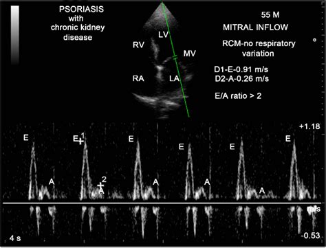 Pulse Wave Doppler Mitral Valve