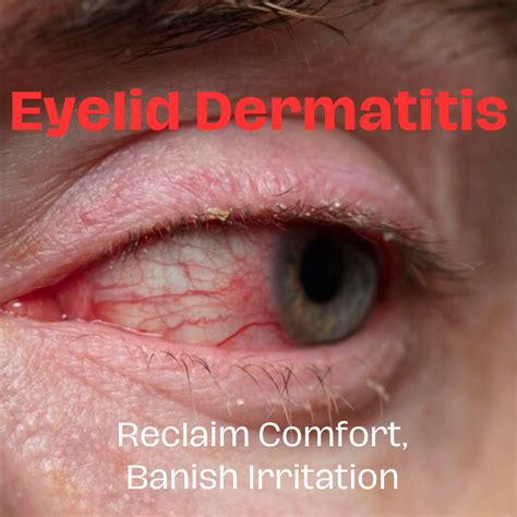 7 Common Myths About Eyelid Dermatitis That Could Ruin Your Skin - Only ...