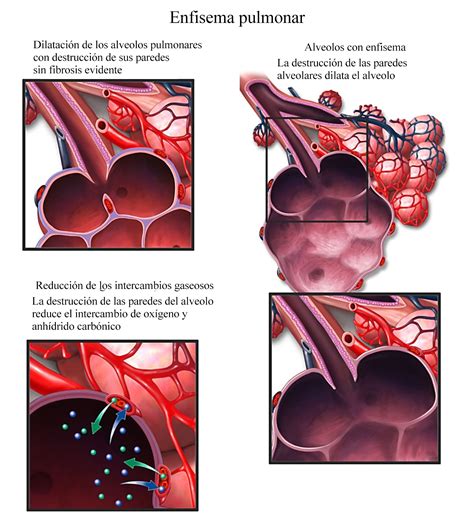 Edema pulmonar diagnóstico tratamiento y pronóstico