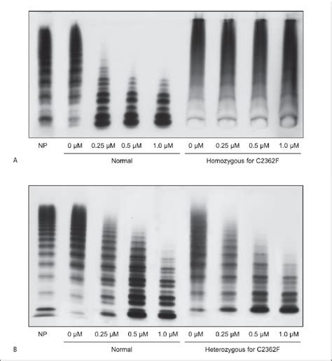 Effect Of Adamts13 On Patients And Normal Vwf Multimer Pattern Download Scientific Diagram