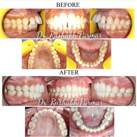 Orthosmile Multispeciality Dental Clinic Management Of Class I