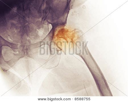 Degenerative Fibroid