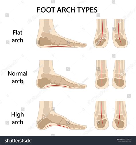 Set Foot Arch Types Vector Illustration: Vector có sẵn (miễn phí bản ...