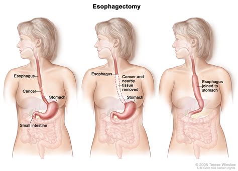 Esophageal Cancer Treatment - NCI