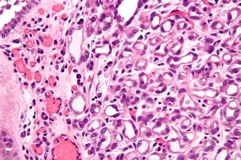 Nephrogenic Adenoma Libre Pathology