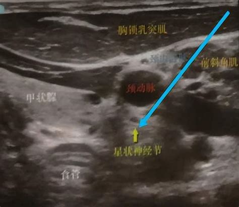 神奇的星状神经节人体舒适度开关 副交感神经 神经节 舒适度 禁忌症 星状 健康界