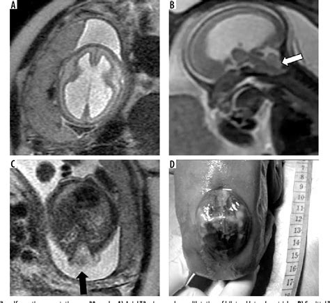 Figure 1 From Imaging Spectrum Of Posterior Fossa Anomalies On Foetal