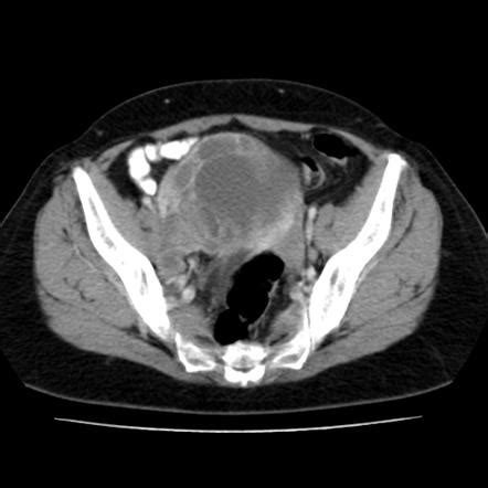 Endometrial Carcinoma Radiology Reference Article Radiopaedia Org