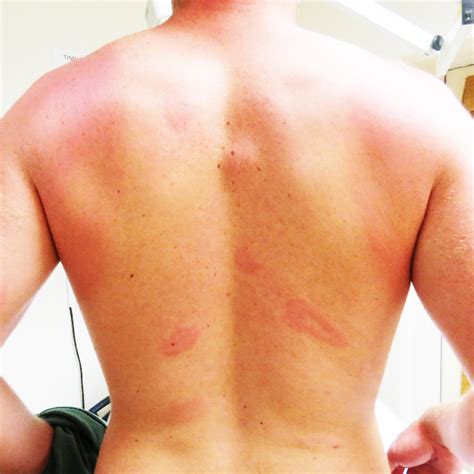 The Myth Of The Bullseye Why Recognizing The Spectrum Of Lyme Disease Rashes Is Critical For