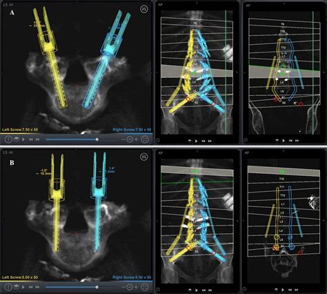 A Robotic Software Plan Demonstrating Pedicle Screws Planned In