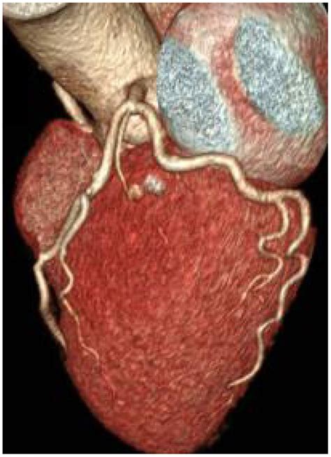 Typical Image Of Coronary CT Angiography CCTA Volume Rendering In The