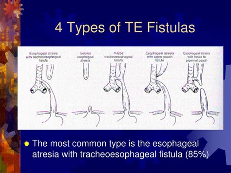 Fistula Types