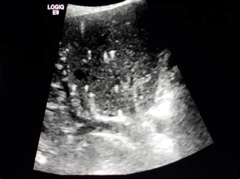 Figure 2 From Imaging Findings Of Biliary Hamartomas Semantic Scholar