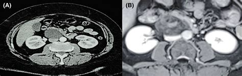 Retroperitoneal Schwannoma Uncommon Location Of A Benign Tumor