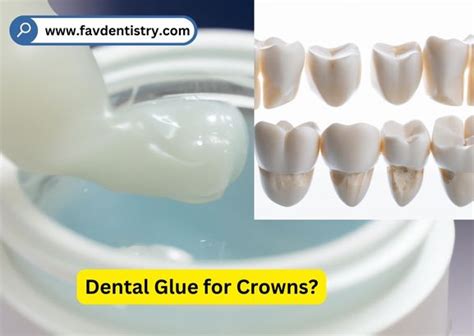 Types Of Dental Crowns Favourite Dentistry